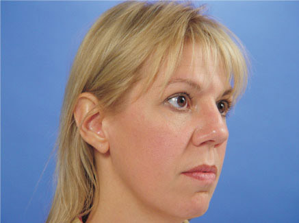 Photo of Patient 22 Before Primary Rhinoplasty