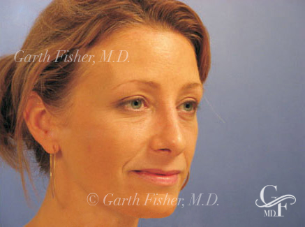 Photo of Patient 22 After Primary Rhinoplasty