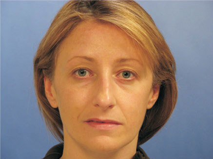 Photo of Patient 23 Before Primary Rhinoplasty
