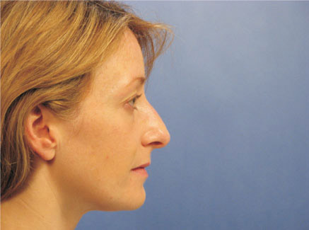 Photo of Patient 23 Before Primary Rhinoplasty