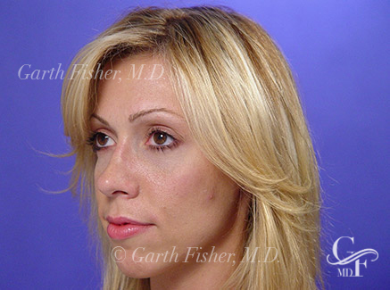 Photo of Patient 24 After Primary Rhinoplasty