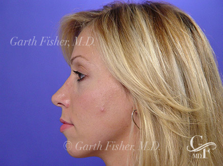 Photo of Patient 24 After Primary Rhinoplasty