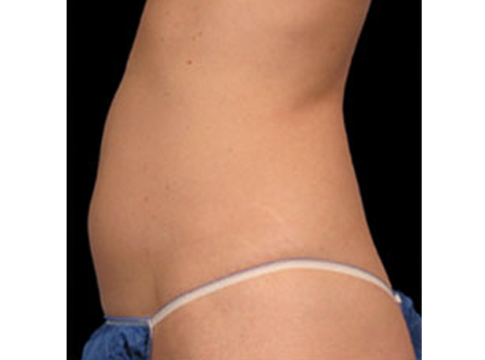Photo of Patient 02 Before Coolsculpting