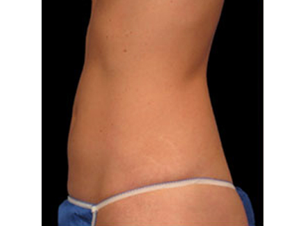 Photo of Patient 02 After Coolsculpting