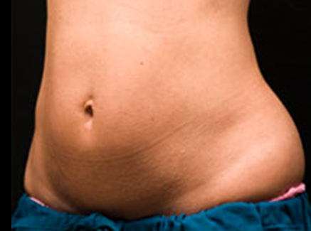 Photo of Patient 03 Before Coolsculpting