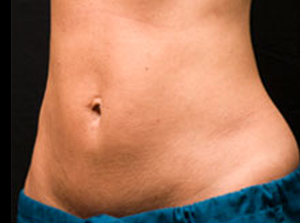 Photo of Patient 03 After Coolsculpting
