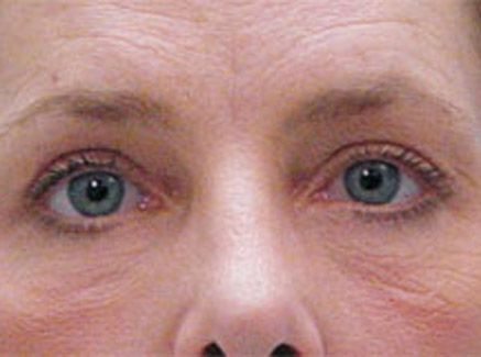 Photo of Patient 01 Before Skin/Laser Treatments