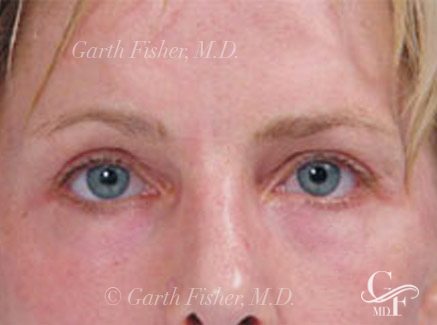 Photo of Patient 01 After Skin/Laser Treatments