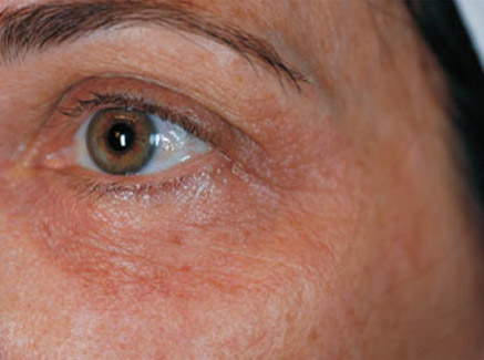 Photo of Patient 02 Before Skin/Laser Treatments