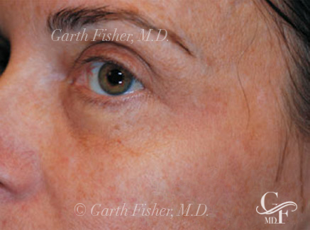 Photo of Patient 02 After Skin/Laser Treatments