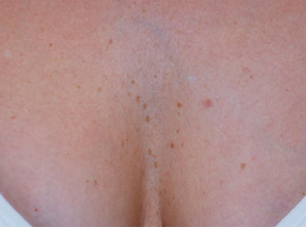 Photo of Patient 03 Before Skin/Laser Treatments