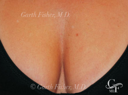 Photo of Patient 03 After Skin/Laser Treatments