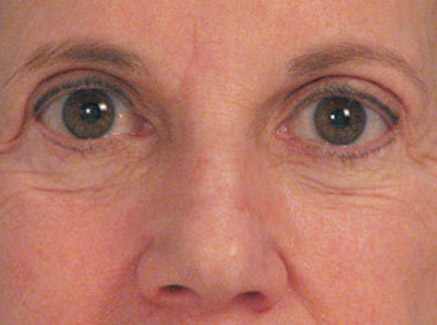 Photo of Patient 04 Before Skin/Laser Treatments