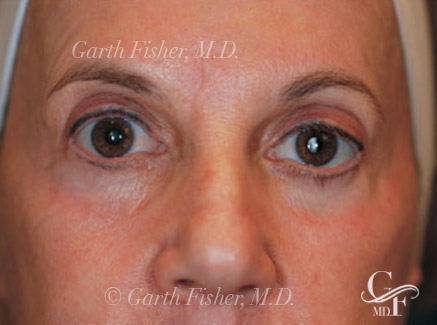 Photo of Patient 04 After Skin/Laser Treatments