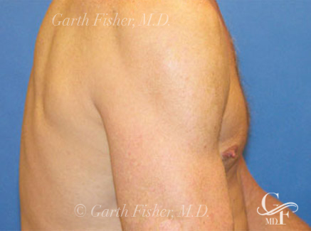 Photo of Patient 08 After Skin/Laser Treatments
