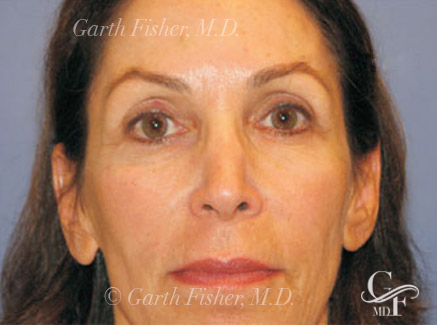 Photo of Patient 09 After Skin/Laser Treatments