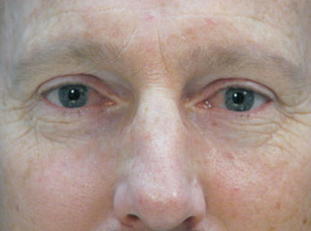 Photo of Patient 10 Before Skin/Laser Treatments