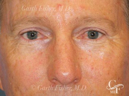 Photo of Patient 10 After Skin/Laser Treatments