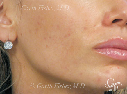 Photo of Patient 11 After Skin/Laser Treatments