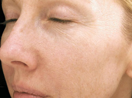 Photo of Patient 12 Before Skin/Laser Treatments