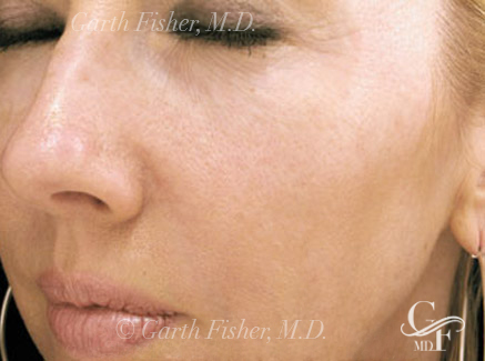 Photo of Patient 12 After Skin/Laser Treatments