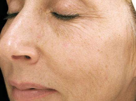 Photo of Patient 13 Before Skin/Laser Treatments