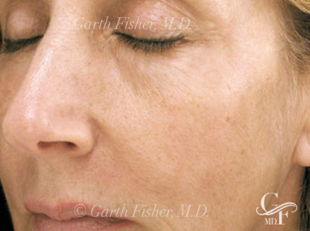 Photo of Patient 13 After Skin/Laser Treatments