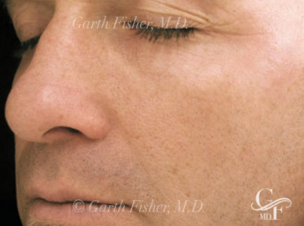 Photo of Patient 14 After Skin/Laser Treatments