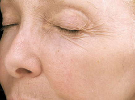 Photo of Patient 15 Before Skin/Laser Treatments