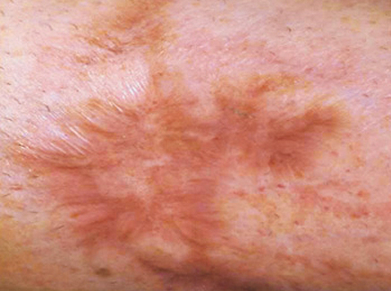 Photo of Patient 20 Before Skin/Laser Treatments