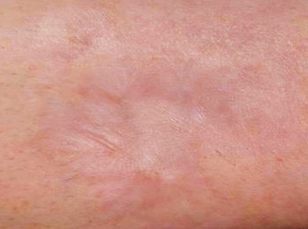 Photo of Patient 20 After Skin/Laser Treatments
