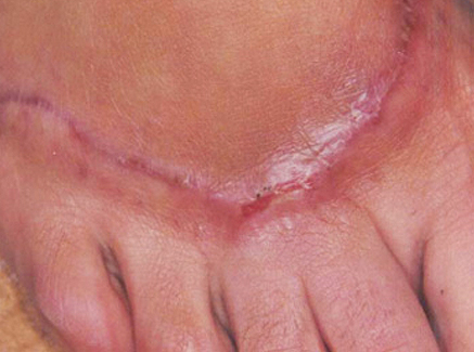 Photo of Patient 21 Before Skin/Laser Treatments