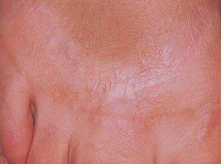 Photo of Patient 21 After Skin/Laser Treatments