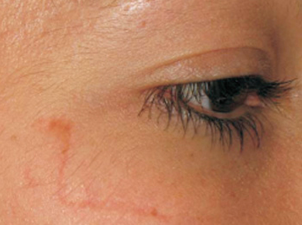 Photo of Patient 22 Before Skin/Laser Treatments