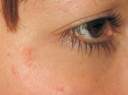 Photo of Patient 22 After Skin/Laser Treatments