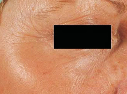 Photo of Patient 24 Before Skin/Laser Treatments