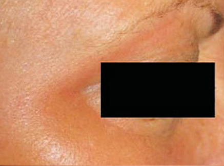 Photo of Patient 24 After Skin/Laser Treatments