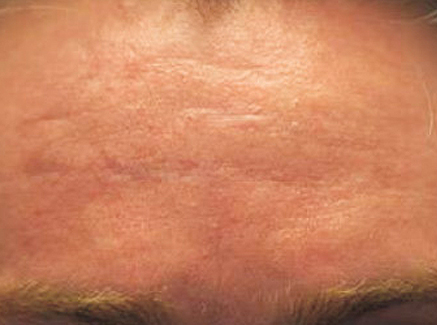 Photo of Patient 25 Before Skin/Laser Treatments