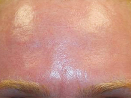 Photo of Patient 25 After Skin/Laser Treatments
