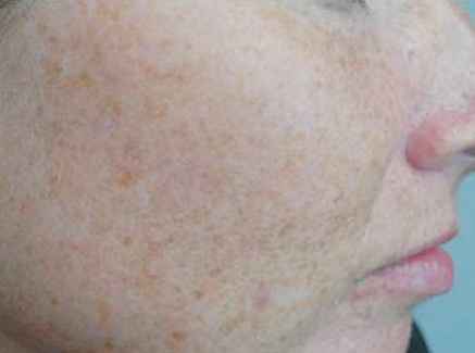 Photo of Patient 26 Before Skin/Laser Treatments