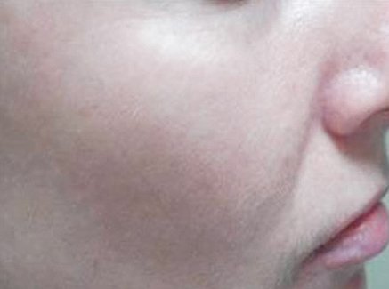 Photo of Patient 26 After Skin/Laser Treatments