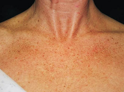 Photo of Patient 27 Before Skin/Laser Treatments