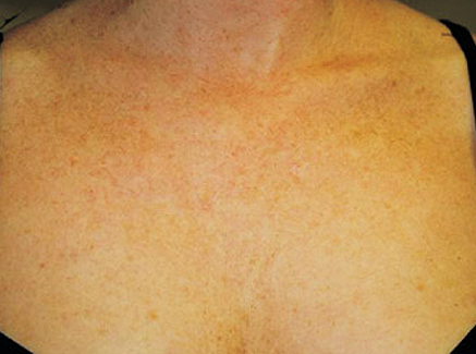 Photo of Patient 27 After Skin/Laser Treatments