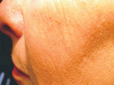 Photo of Patient 30 After Skin/Laser Treatments