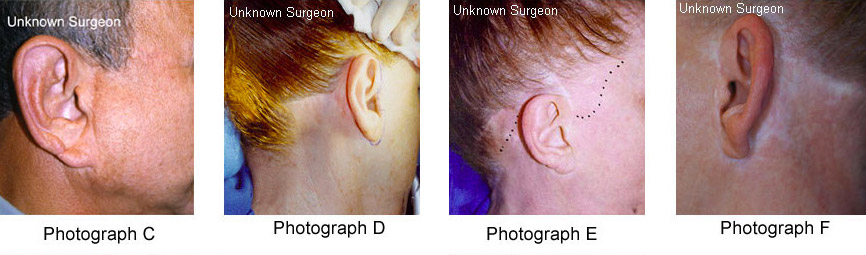 Examples of Traditional Facelift Technique