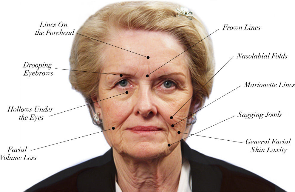 Diagram of Woman Before Facelift Surgery