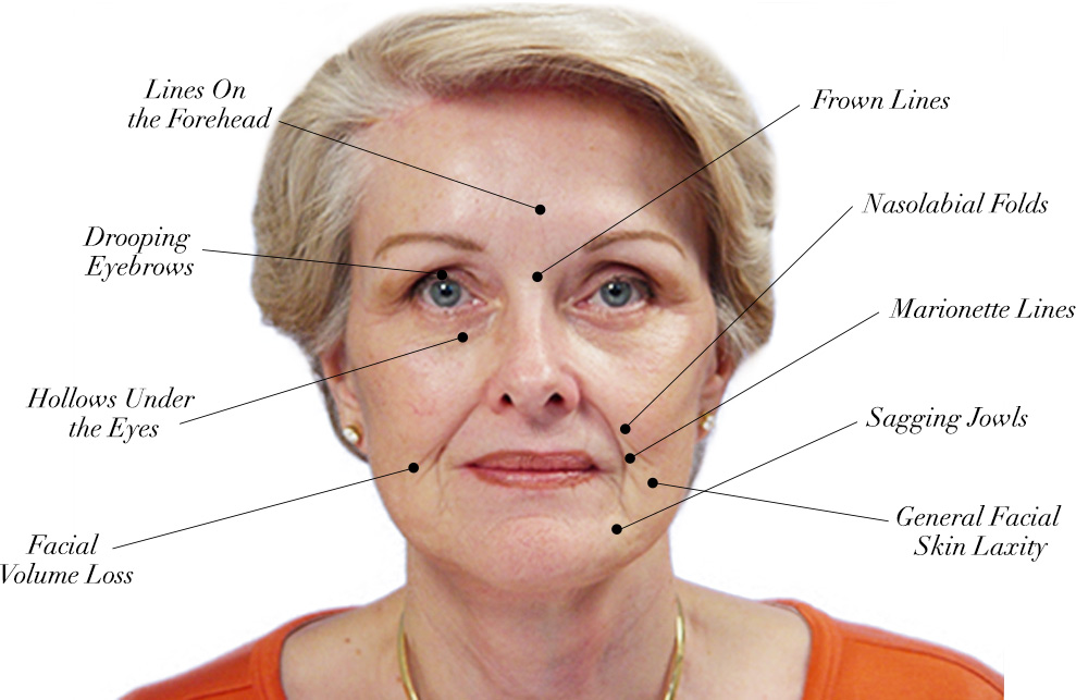 Diagram of Woman After Facelift Surgery